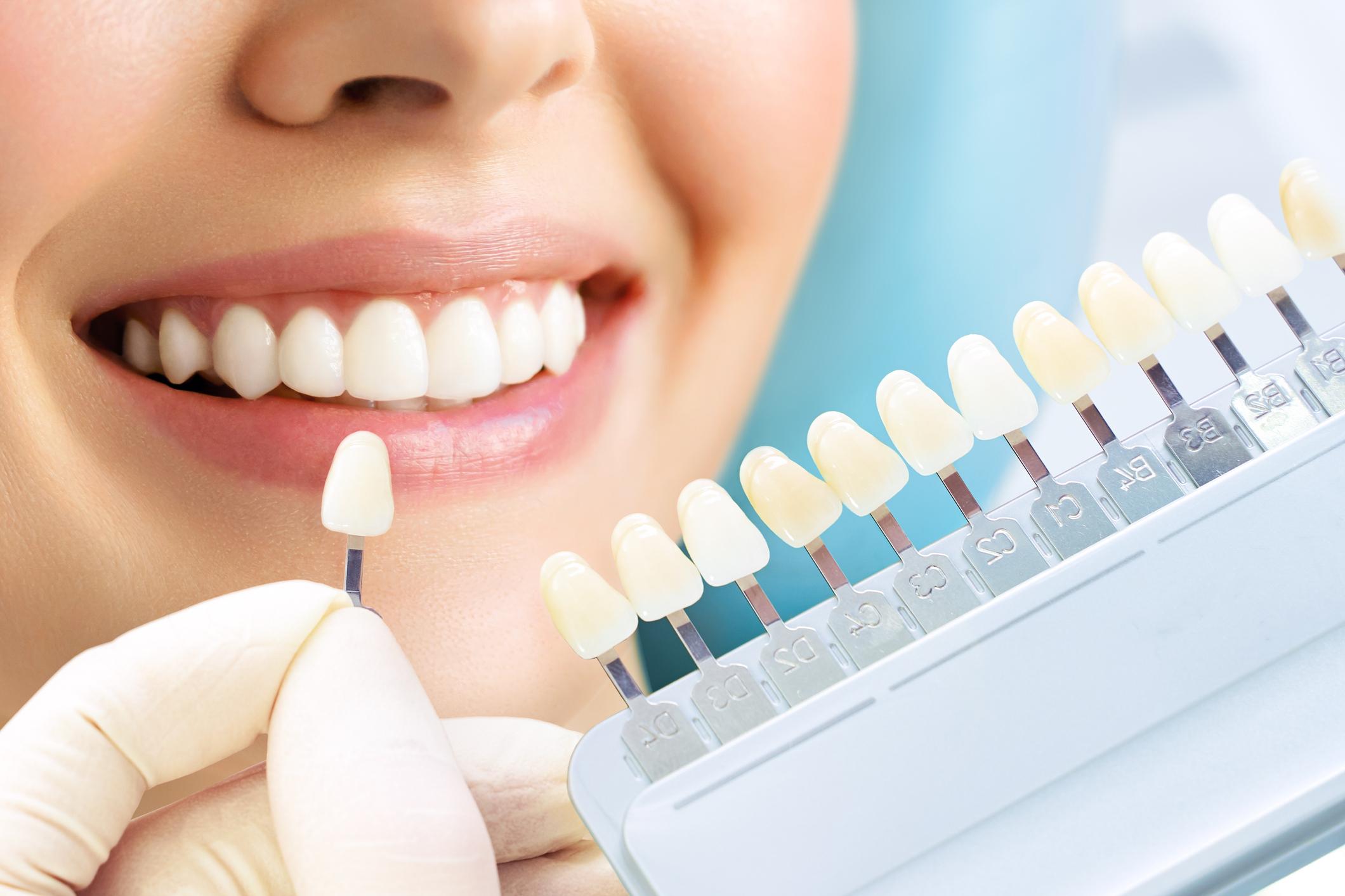 Teeth Whitening